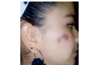 Gas pimienta, el dilema de cargarlo sin usarlo: caso de mujer atacada en Pácora